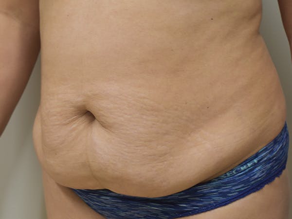 Tummy Tuck Before & After Gallery - Patient 340371 - Image 3
