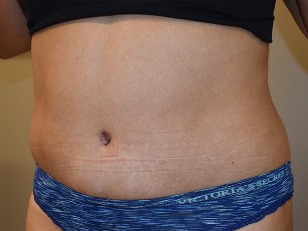 Tummy Tuck Before & After Gallery - Patient 340371 - Image 4