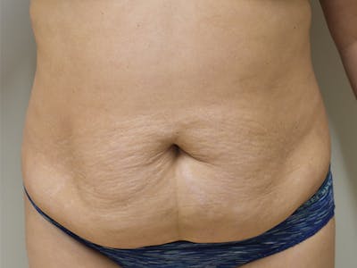 Tummy Tuck Before & After Gallery - Patient 340371 - Image 1