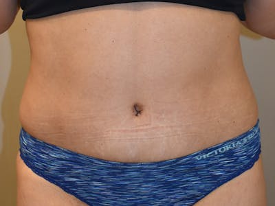 Tummy Tuck Before & After Gallery - Patient 340371 - Image 2