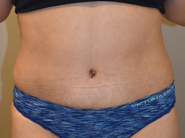 Tummy Tuck Before & After Gallery - Patient 340371 - Image 2