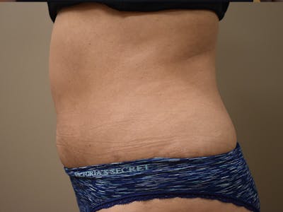 Tummy Tuck Before & After Gallery - Patient 340371 - Image 6