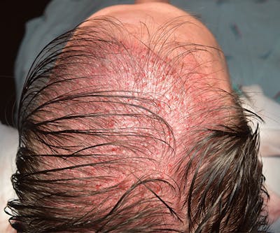 Hair Restoration Before & After Gallery - Patient 107777 - Image 1