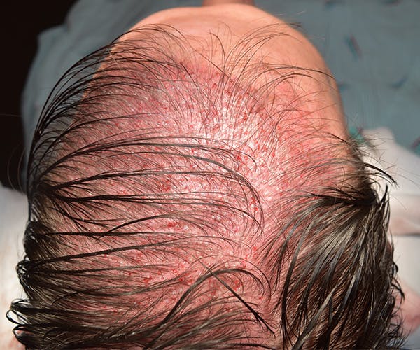 Hair Restoration Before & After Gallery - Patient 107777 - Image 1