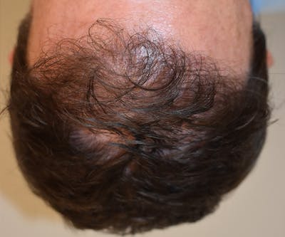 Hair Restoration Before & After Gallery - Patient 107777 - Image 2