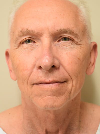 Facelift Before & After Gallery - Patient 332683 - Image 1