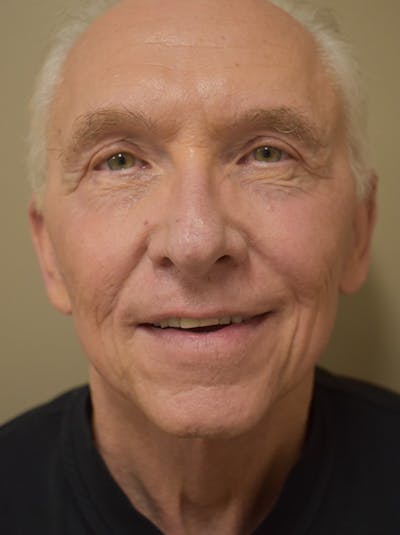 Facelift Before & After Gallery - Patient 332683 - Image 2