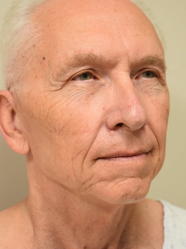 Facelift Before & After Gallery - Patient 332683 - Image 3