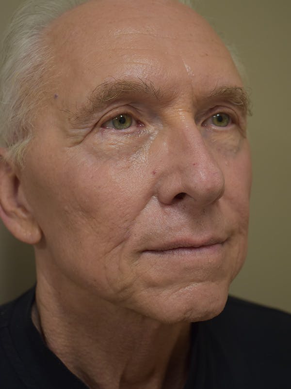 Facelift Before & After Gallery - Patient 332683 - Image 4