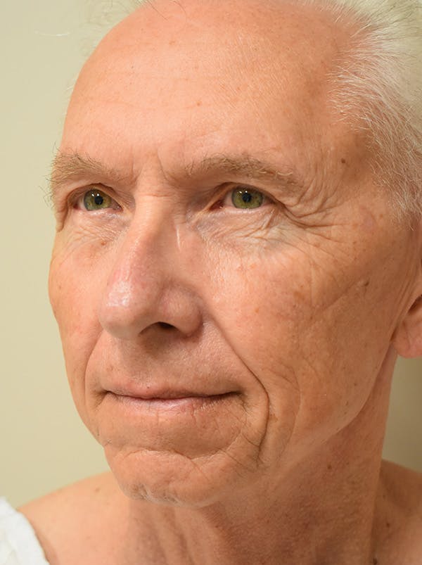 Facelift Before & After Gallery - Patient 332683 - Image 5