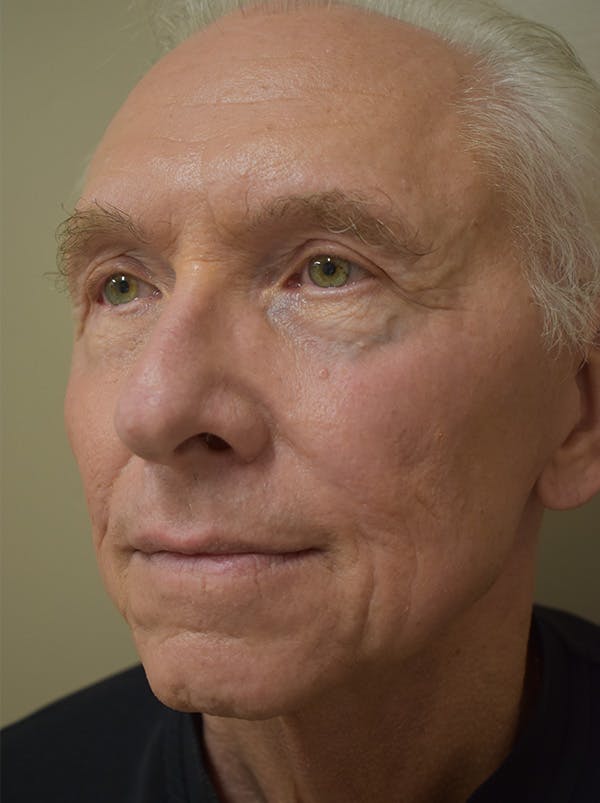 Facelift Before & After Gallery - Patient 332683 - Image 6