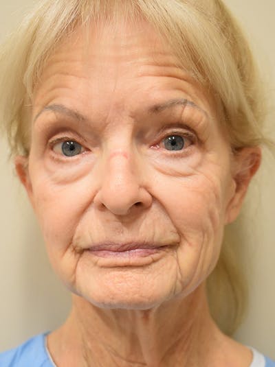 Eyelid Surgery Before & After Gallery - Patient 248483 - Image 1