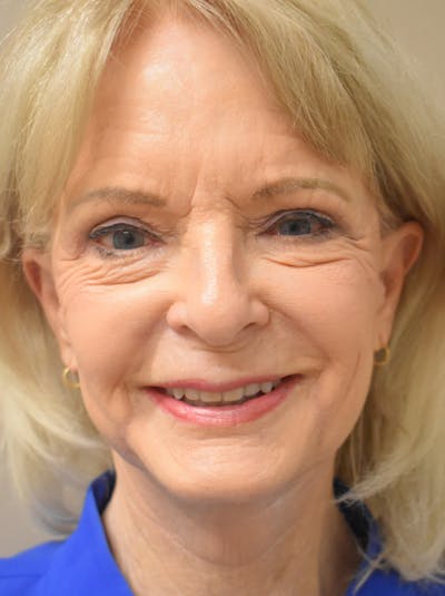Eyelid Surgery Before & After Gallery - Patient 248483 - Image 2