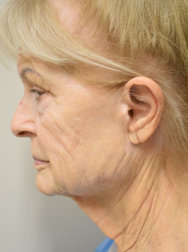 Eyelid Surgery Before & After Gallery - Patient 248483 - Image 3