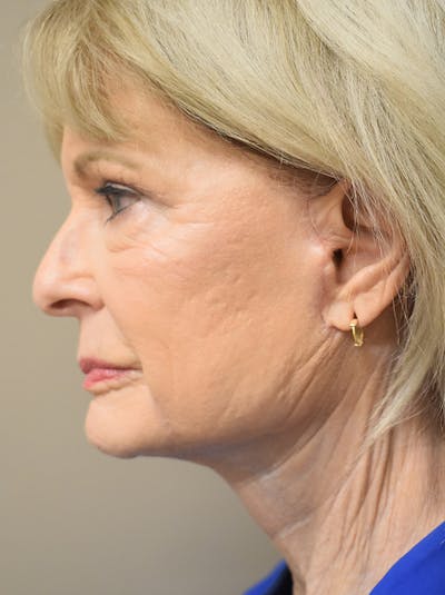 Eyelid Surgery Before & After Gallery - Patient 248483 - Image 4