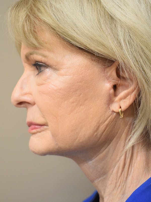 Eyelid Surgery Before & After Gallery - Patient 248483 - Image 4