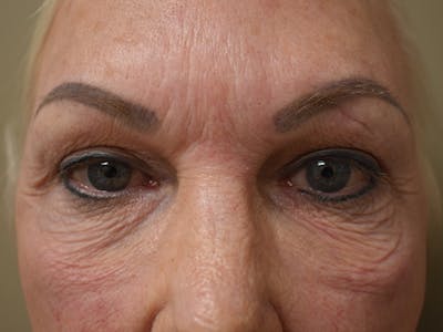 Eyelid Surgery Before & After Gallery - Patient 136631 - Image 1