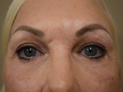 Eyelid Surgery Before & After Gallery - Patient 136631 - Image 2