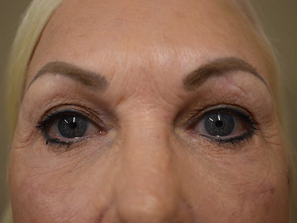 Eyelid Surgery Before & After Gallery - Patient 136631 - Image 2