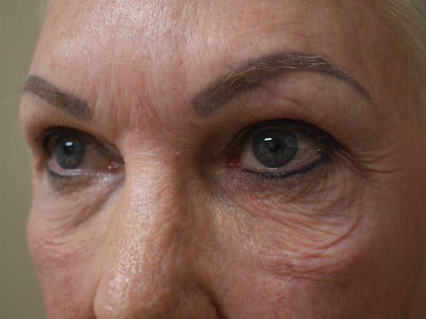 Eyelid Surgery Before & After Gallery - Patient 136631 - Image 3