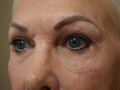 Eyelid Surgery Before & After Gallery - Patient 136631 - Image 4