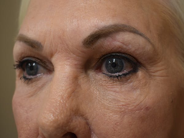 Eyelid Surgery Before & After Gallery - Patient 136631 - Image 4