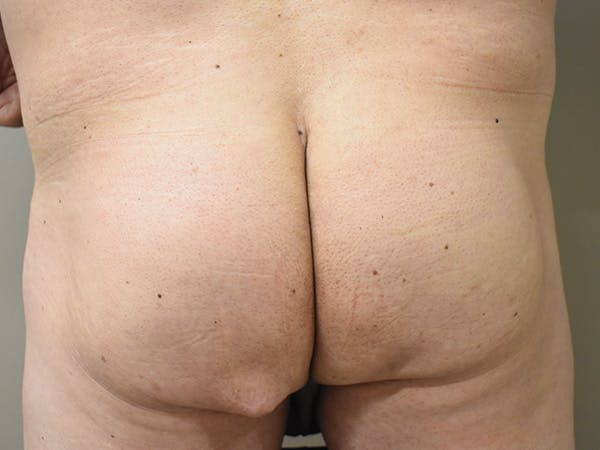 Buttox Before & After Gallery - Patient 114458 - Image 1