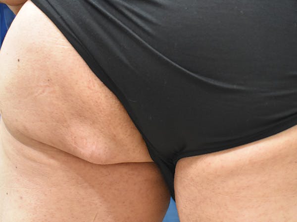 Buttox Before & After Gallery - Patient 114458 - Image 3