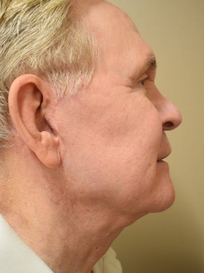 Facelift Before & After Gallery - Patient 723556 - Image 2