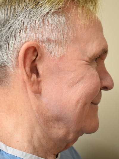Facelift Before & After Gallery - Patient 723556 - Image 1