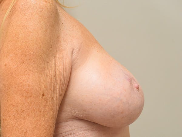 Breast Correction Before & After Gallery - Patient 159733 - Image 5