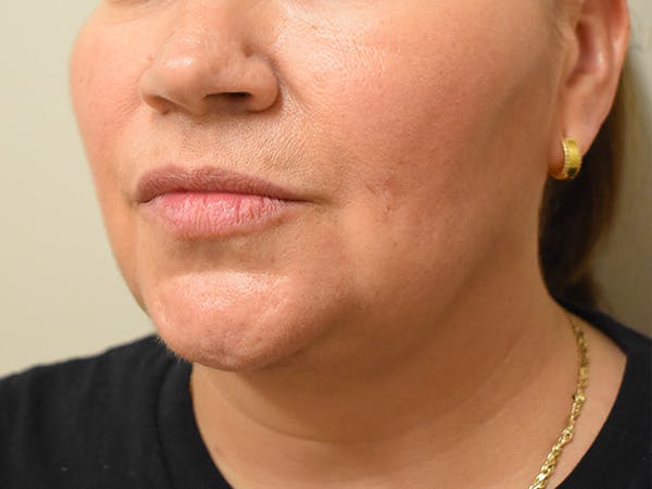 Submental Liposuction Before & After Gallery - Patient 315334 - Image 2