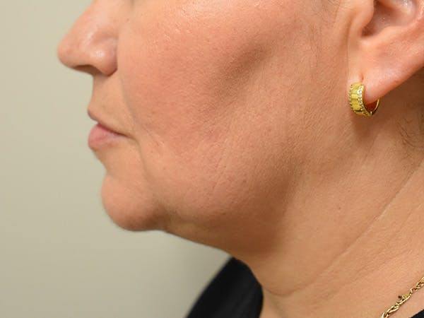 Submental Liposuction Before & After Gallery - Patient 315334 - Image 4