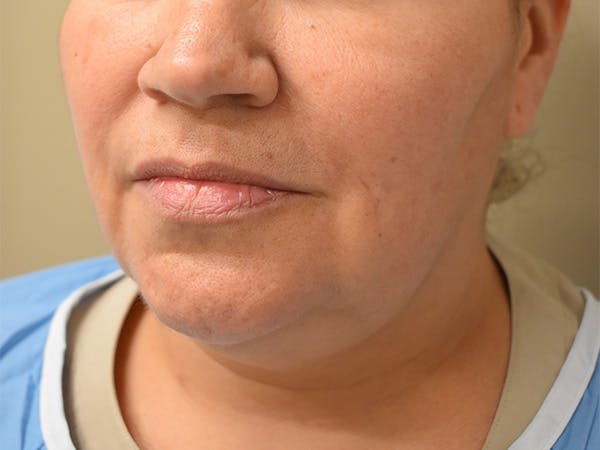 Submental Liposuction Before & After Gallery - Patient 315334 - Image 1