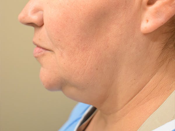 Submental Liposuction Before & After Gallery - Patient 315334 - Image 3