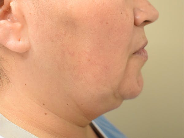 Chin Tuck Before & After Gallery - Patient 414436 - Image 1