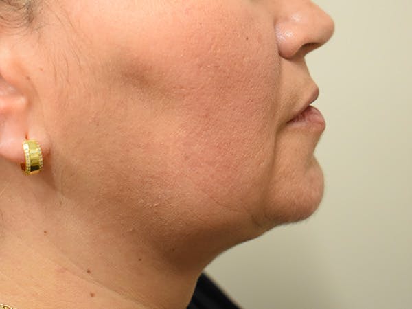 Chin Tuck Before & After Gallery - Patient 414436 - Image 2