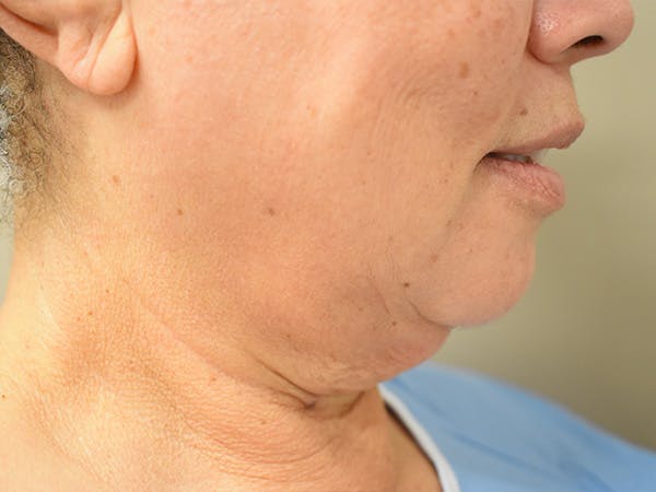 Chin Tuck Before & After Gallery - Patient 414436 - Image 3
