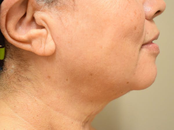 Chin Tuck Before & After Gallery - Patient 414436 - Image 4