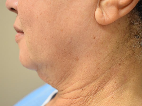 Chin Tuck Before & After Gallery - Patient 414436 - Image 5