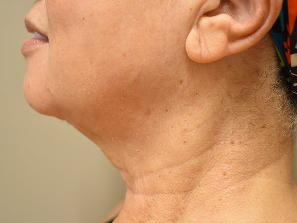 Chin Tuck Before & After Gallery - Patient 414436 - Image 6