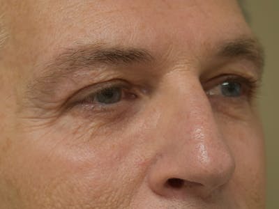 Eyelid Surgery Before & After Gallery - Patient 274816 - Image 2