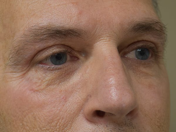 Eyelid Surgery Before & After Gallery - Patient 274816 - Image 1