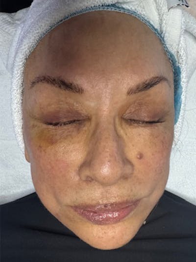 Hydrafacial Before & After Gallery - Patient 969993 - Image 1