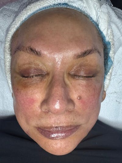 Hydrafacial Before & After Gallery - Patient 969993 - Image 2