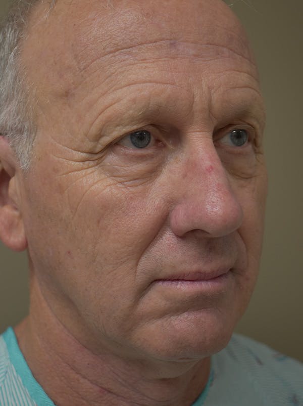 Facelift Before & After Gallery - Patient 126034 - Image 3