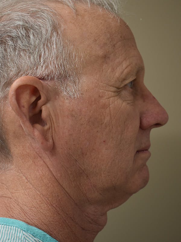 Facelift Before & After Gallery - Patient 126034 - Image 5