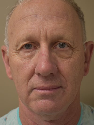 Facelift Before & After Gallery - Patient 126034 - Image 1