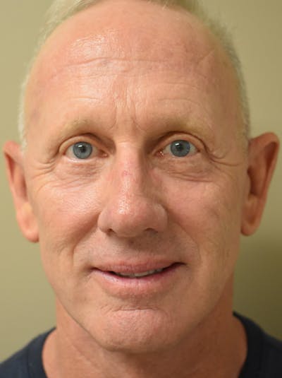 Facelift Before & After Gallery - Patient 126034 - Image 2