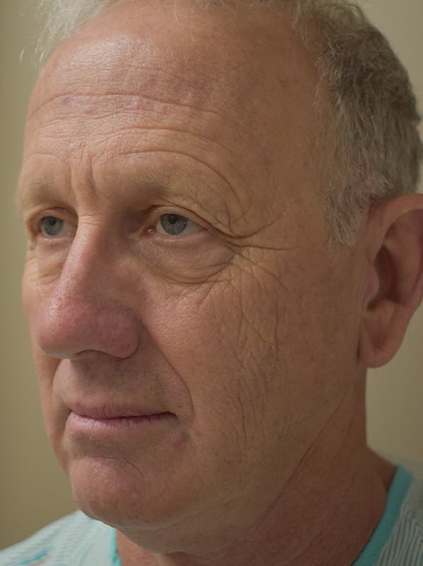 Facelift Before & After Gallery - Patient 126034 - Image 7